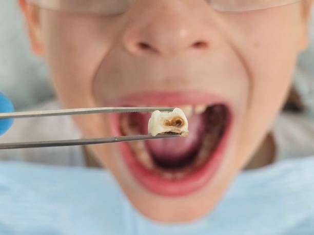 Best Broken or Chipped Tooth Repair in San Joaquin, CA